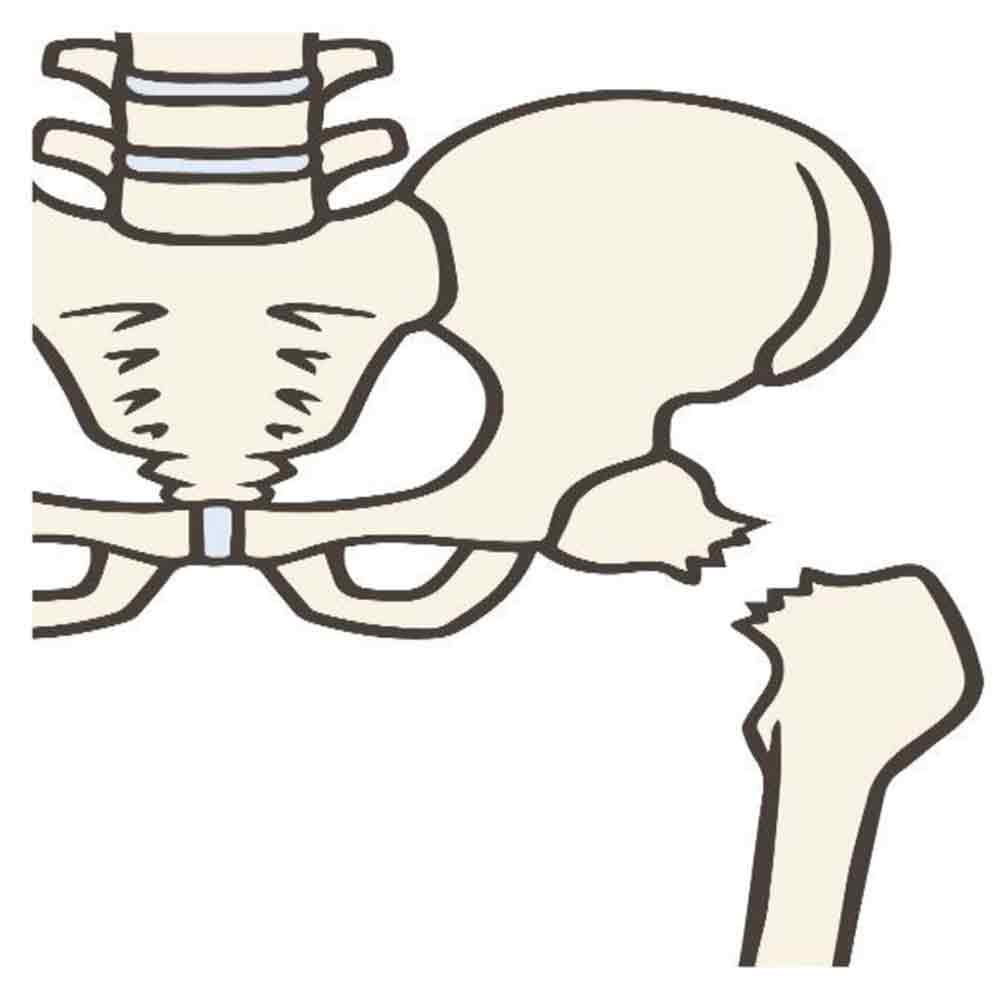 大腿骨頸部骨折1
