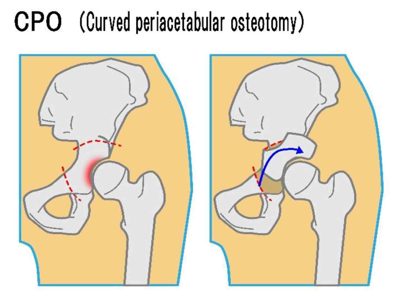 人工股関節置換術（THA）1