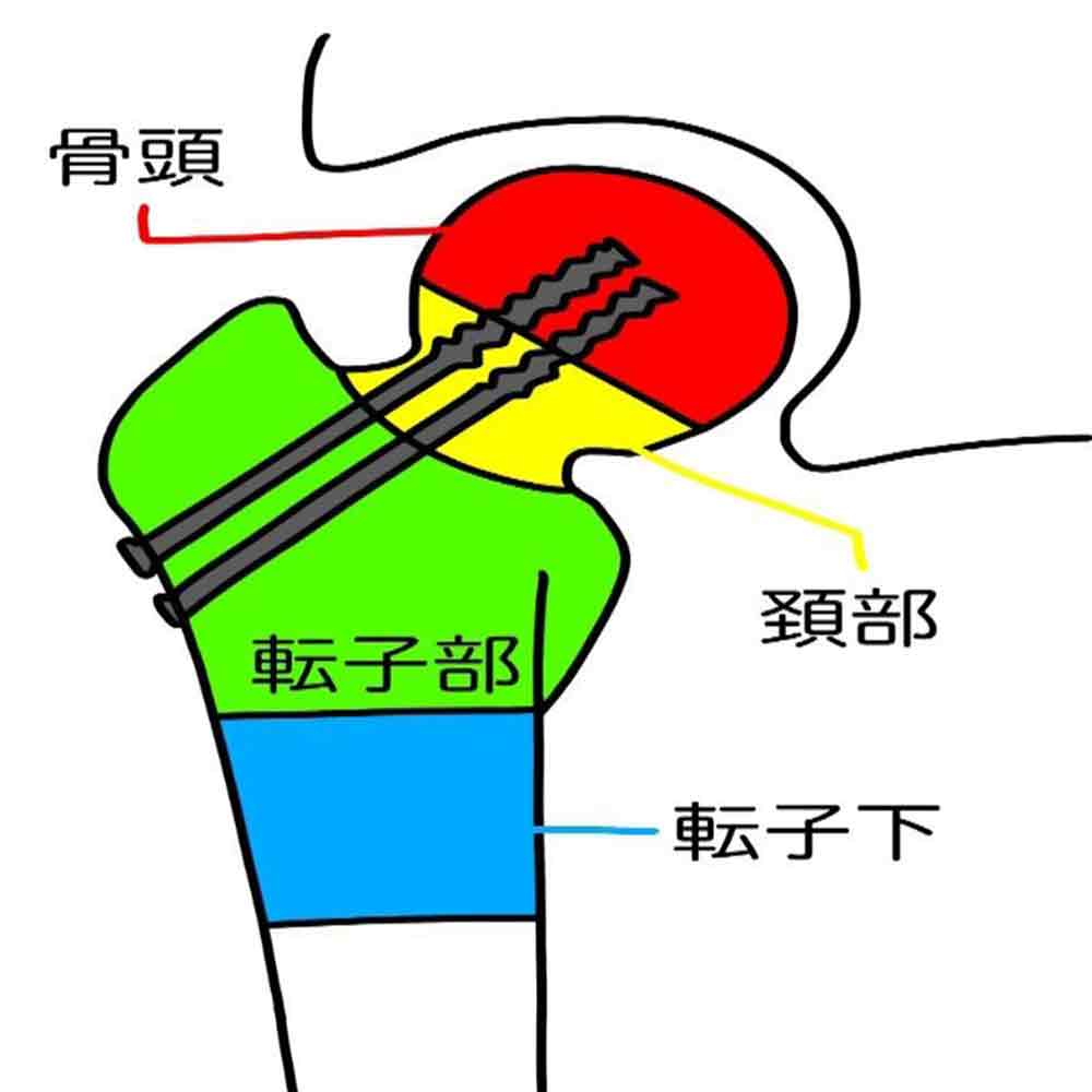 人工股関節置換術（THA）1
